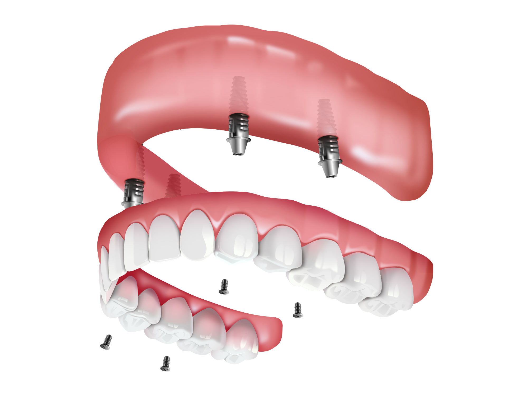 Image of implant demonstration